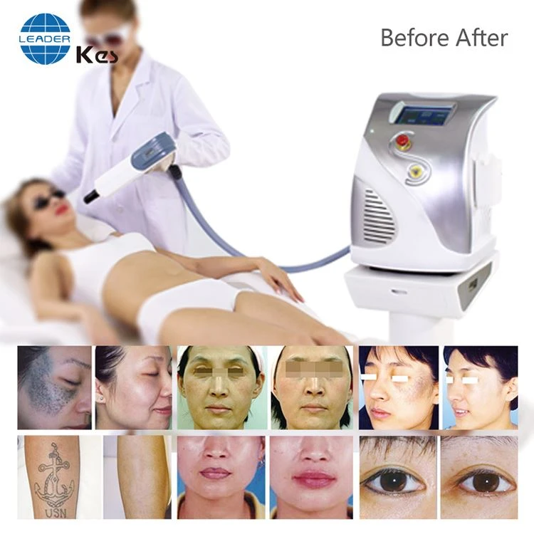 yag laser tattoo equipment