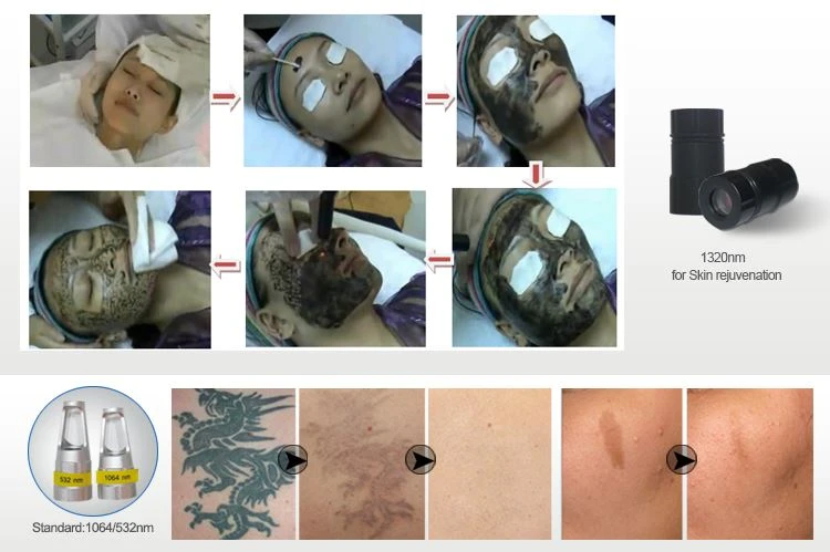 nd yag laser machine