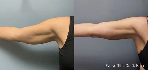 Arm Slim Before After (2)