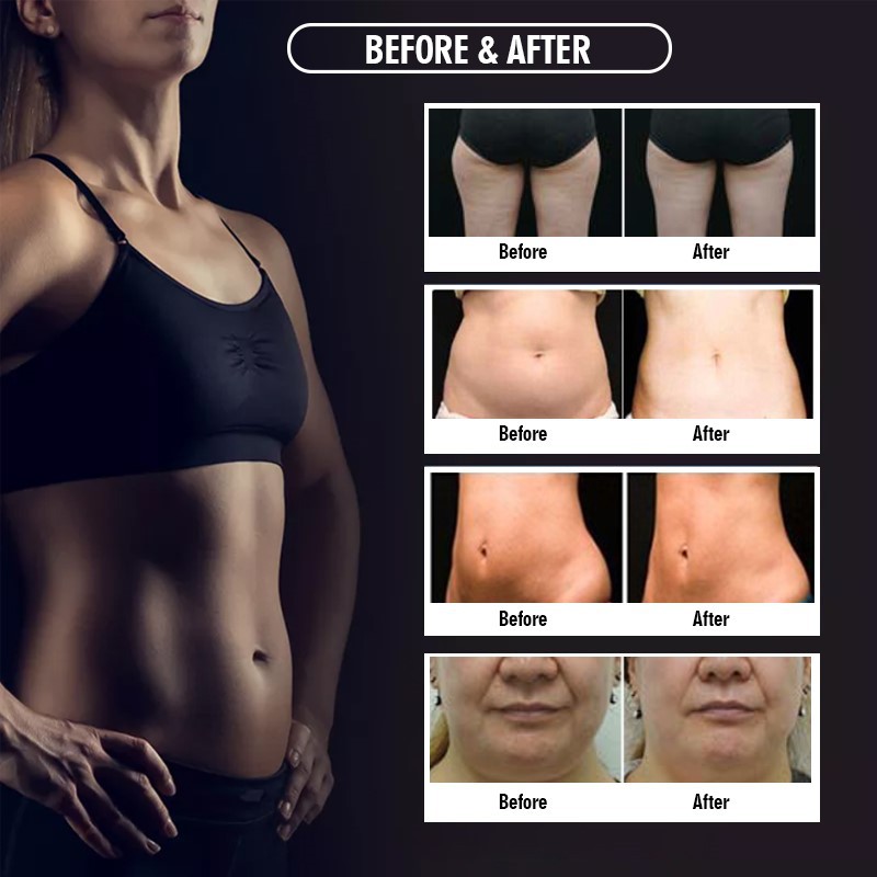 cryolipolysis fat freezing machine before after