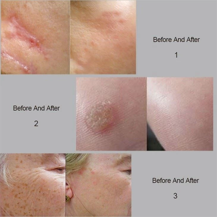 Medical CE Approved Co2 Fractional Laser For Sale