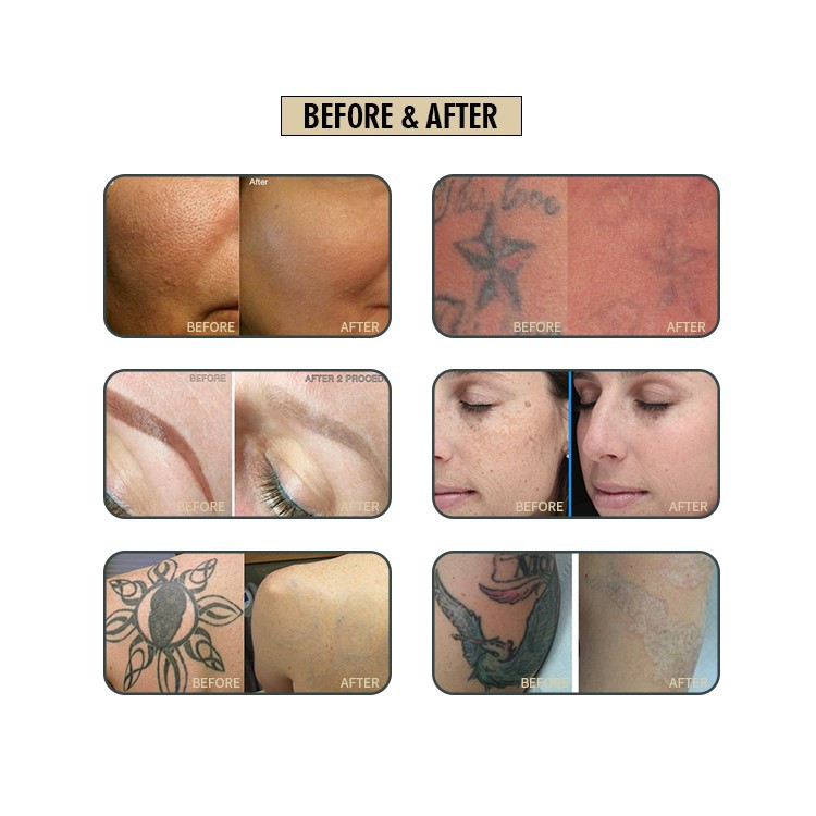 ND YAG laser treatment result ND YAG laser treatment result