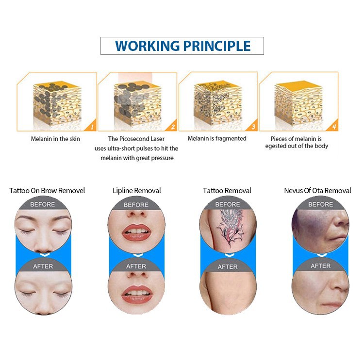 Nd yag laser tattoo removal principle reviews Nd yag laser tattoo removal principle reviews