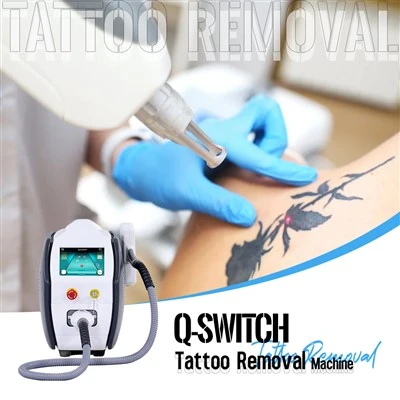 ND YAG Laser Tattoo Removal